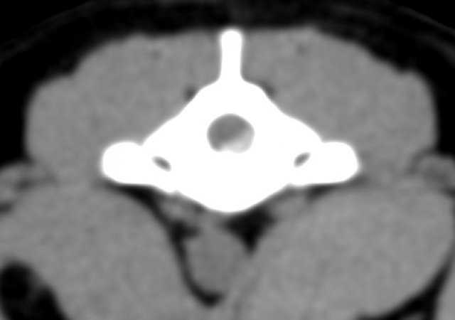 CT Bandscheibe Transversal